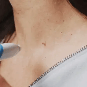 Skin Tag Removal Kit with Applicator Device and Replacement Bands for Small and Regular Skin Tags