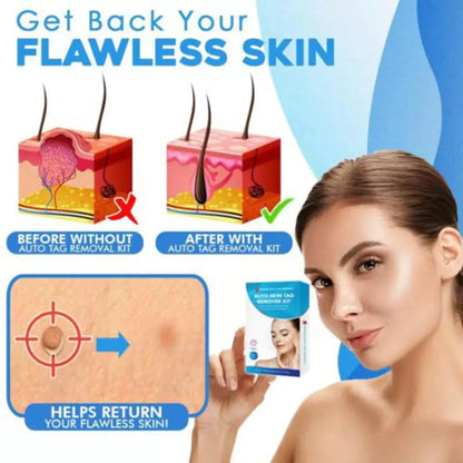 Skin Tag Removal Kit with Applicator Device and Replacement Bands for Small and Regular Skin Tags