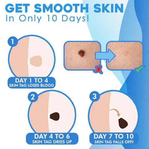 Skin Tag Removal Kit with Applicator Device and Replacement Bands for Small and Regular Skin Tags