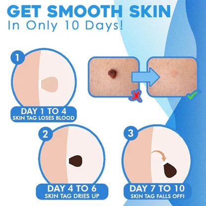 Skin Tag Removal Kit with Applicator Device and Replacement Bands for Small and Regular Skin Tags